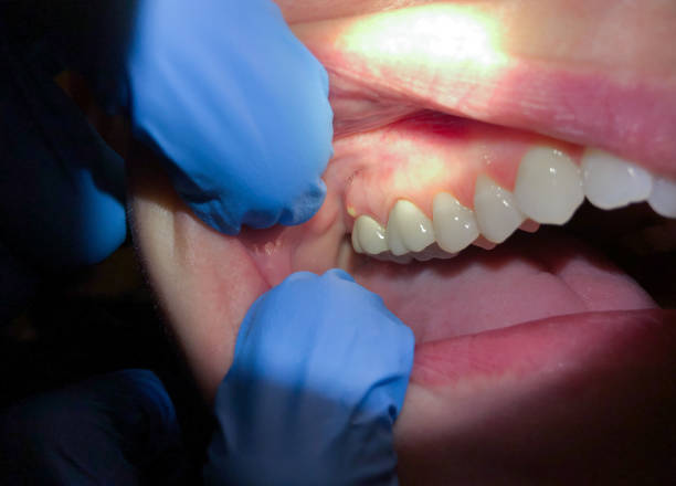 Best Emergency Treatment for Toothache in Eureka, IL